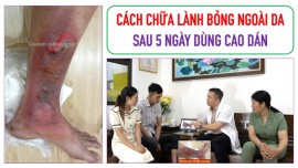 Cách chữa lành bỏng ngoài da sau 5 ngày sử dụng Cao dán