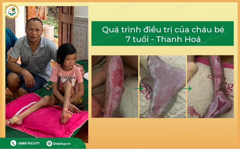 Cách xử lý bỏng