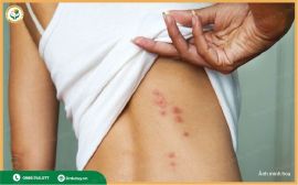 Cách Xử Lý Vết Lở Loét Do Côn Trùng Cắn: An Toàn, Nhanh Lành, Không Để Lại Sẹo
