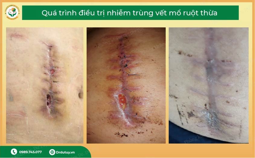 cách xử lý vết mổ rỉ dịch