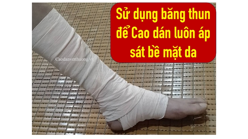 Cần làm gì khi bị bỏng nước sôi