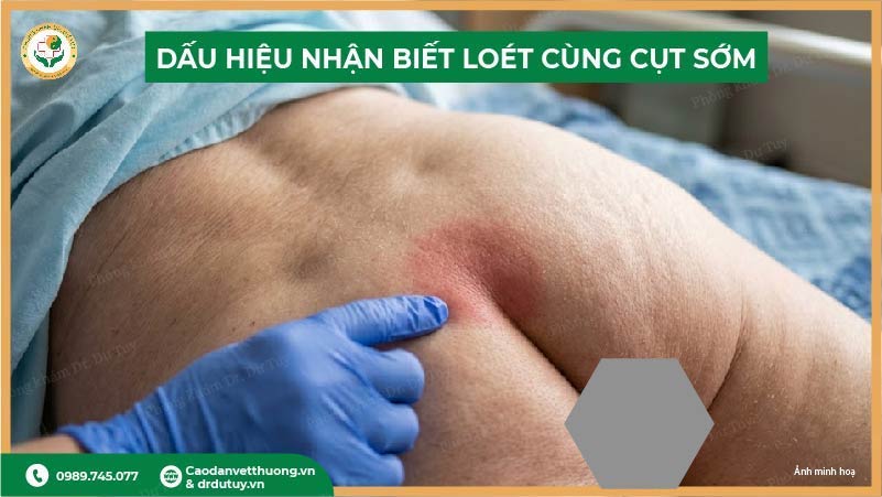 canh-bao-nhan-biet-som-loet-vung-cung-cut-truoc-khi-bien-chung