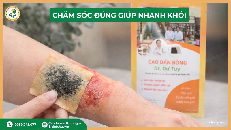 cao dán bỏng hỗ trợ phục hồi da