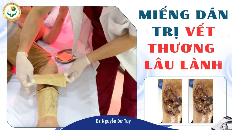 cao dán chăm sóc vết thương cẳng chân lâu lành
