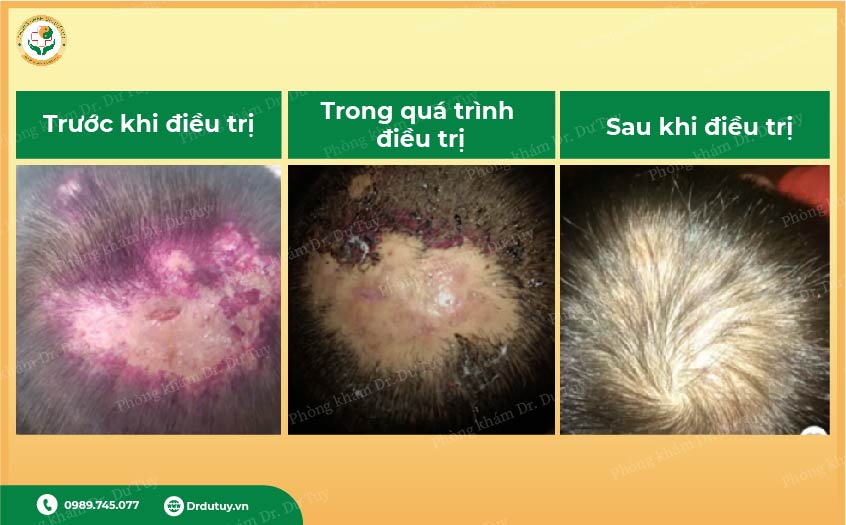 cao-dan-chua-viem-da-o-tre-nho2