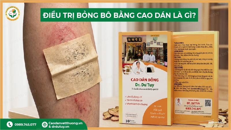 cao dán điều trị bỏng bô xe máy là gì?