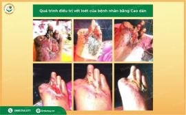 Điều trị khỏi vết thương lộ xương bàn chân nhờ Cao dán Dr Dư Tuy