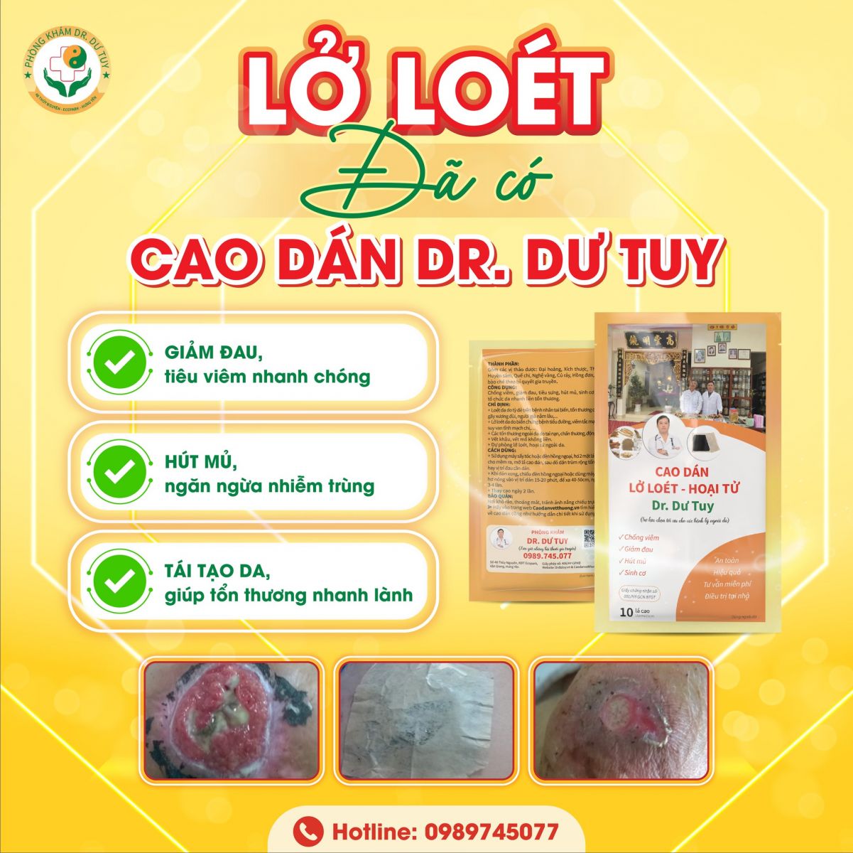 cao-dan-dr-du-tuy-chua-loet-da