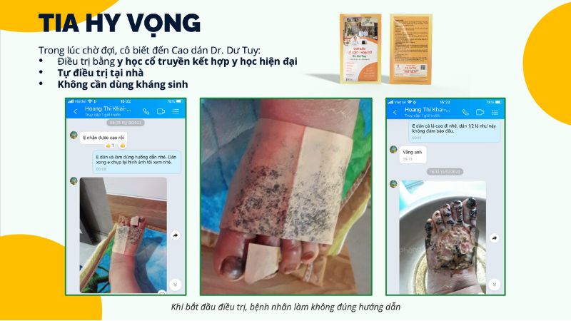 cao-dan-dr-du-tuy-dieu-tri-vet-thuong-ban-chan