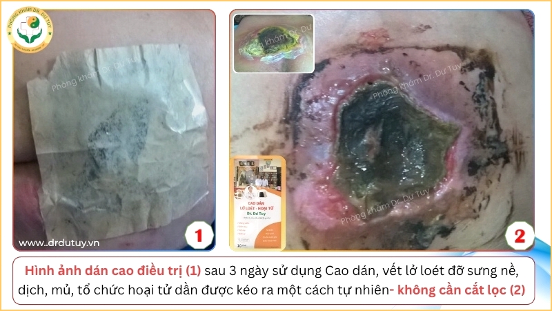 cao-dan-dr-du-tuy-ho-tro-lam-sach-vet-loet