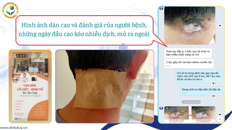 cao-dan-dr-du-tuy-keo-dich-mu-vet-thuong
