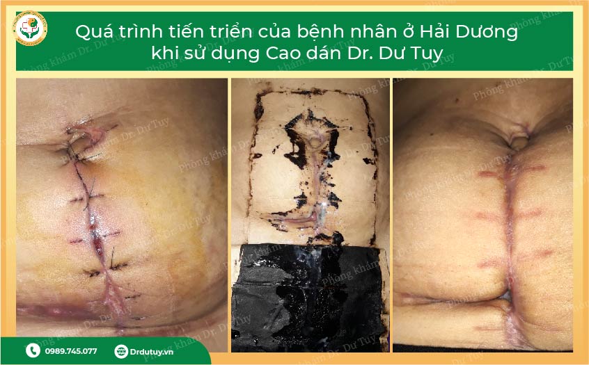 Bác sĩ Tuy chia sẻ một số trường hợp điều trị viêm sau mổ thành công 1. Bệnh nhân sau mổ đẻ bị nhiễm trùng, chảy mủ Một bệnh nhân nữ sau mổ đẻ bị nhiễm trùng vết mổ, vết mổ viêm, sưng đỏ. Sau khi được bác sĩ Tuy tư vấn, sử dụng Cao dán Dr. Dư Tuy trong 3 tuần, tổn thương khô hẳn, lành vết mổ.