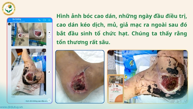 cao-dan-keo-dich-mu-gia-mac-vet-thuong-got-chan