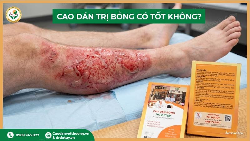 cao dán trị bỏng có tốt không thực tế