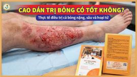 Cao dán trị bỏng có tốt không? Thực tế điều trị cả bỏng nặng, sâu và hoại tử