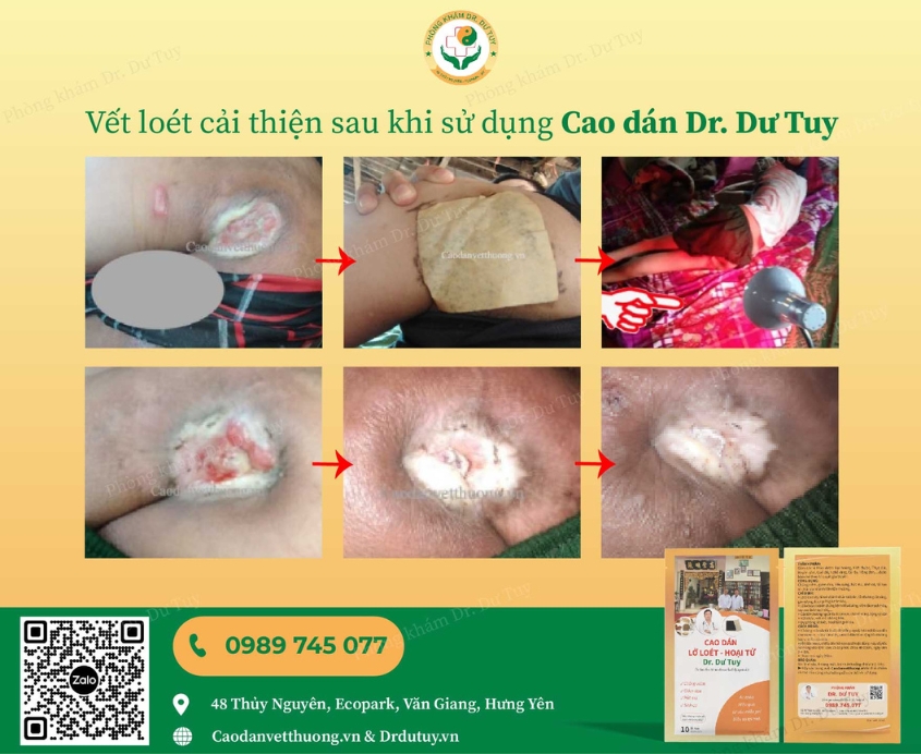 cao-dan-tri-lo-loet-thumb