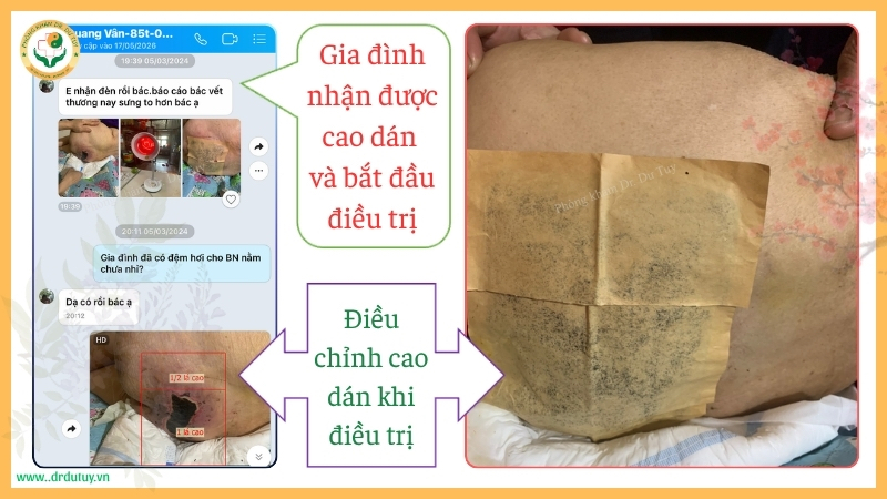 cao dán trị loét da người già tại nhà