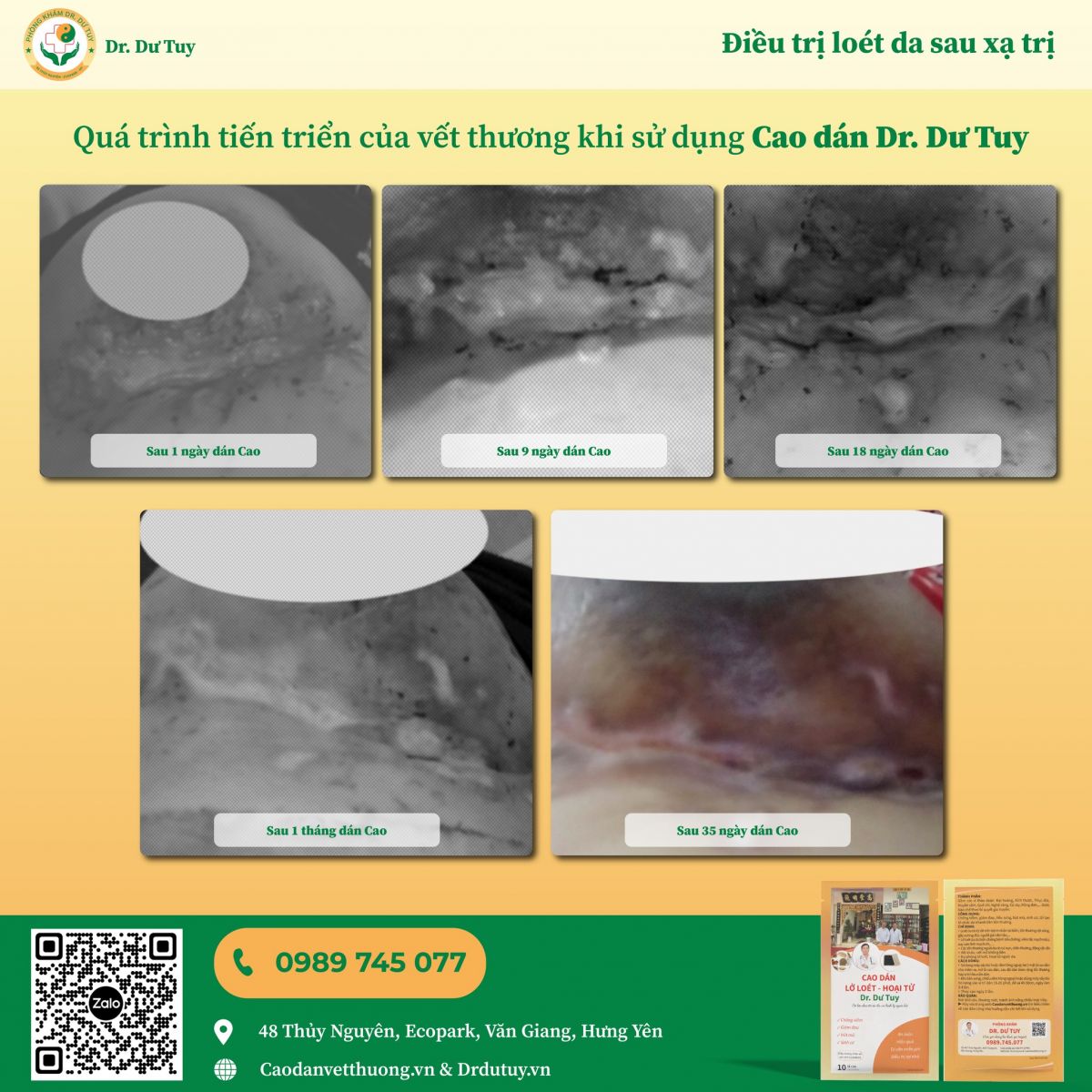 cham-lanh-vet-thuong-o-benh-nhan-ung-thu4