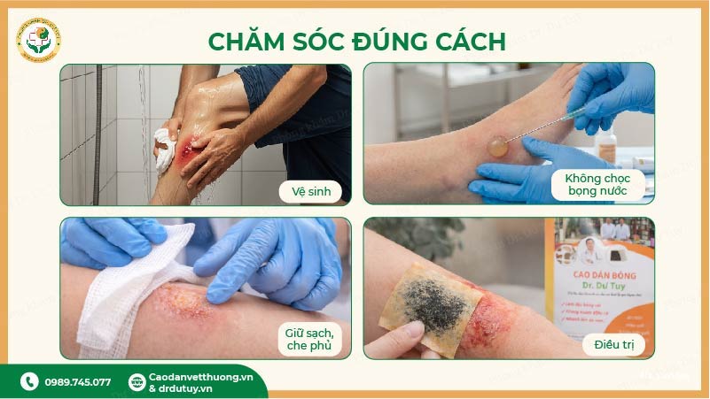 chăm sóc bỏng ngoài da đúng cách