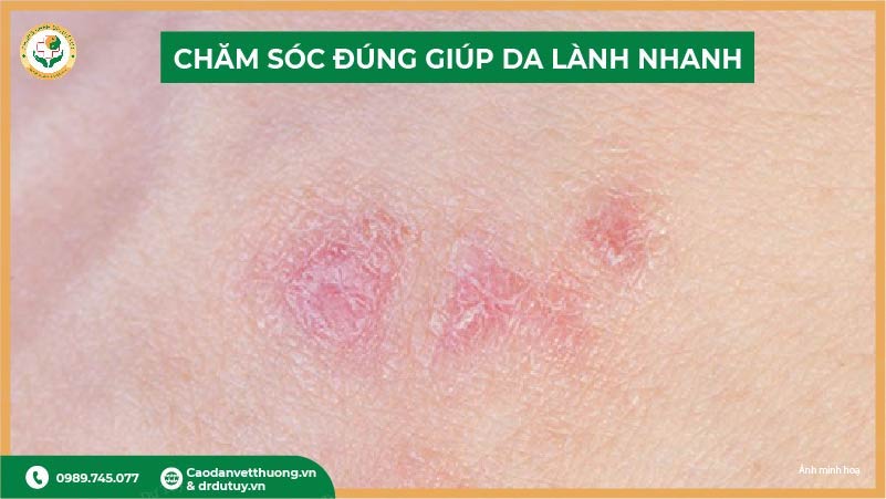 chăm sóc đúng giúp bỏng nhẹ nhanh lành