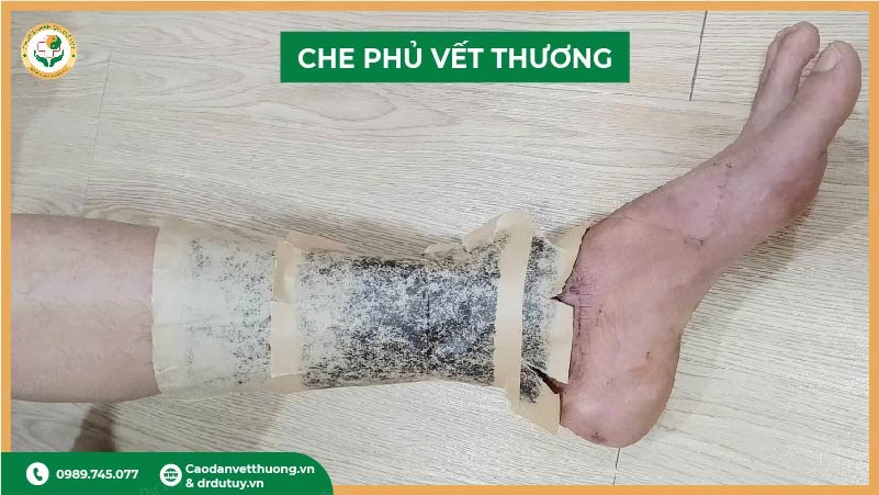 che phủ vết thương bằng cao dán