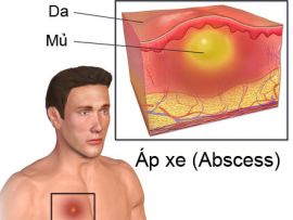 Chữa áp xe da an toàn cho người lớn và trẻ nhỏ