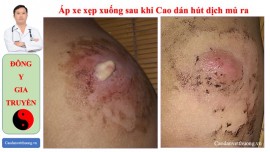 Chữa áp xe da không cần chích rạch