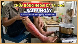 Chữa bỏng ngoài da tại nhà sau 5 ngày: Cách chăm sóc đúng giúp nhanh lành