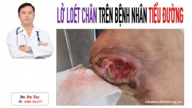 Chữa khỏi loét da do tiểu đường nhờ Cao dán gia truyền