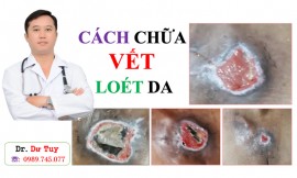 Chữa khỏi loét tì đè lâu năm nhờ Cao dán gia truyền