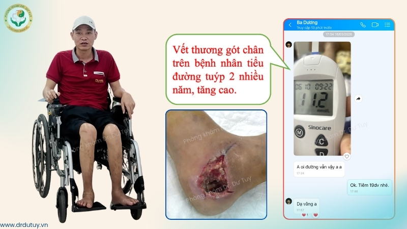 chua-lanh-vet-thuong-got-chan-cho-benh-nhan-tieu-duong-bi-liet-do-tai-nan