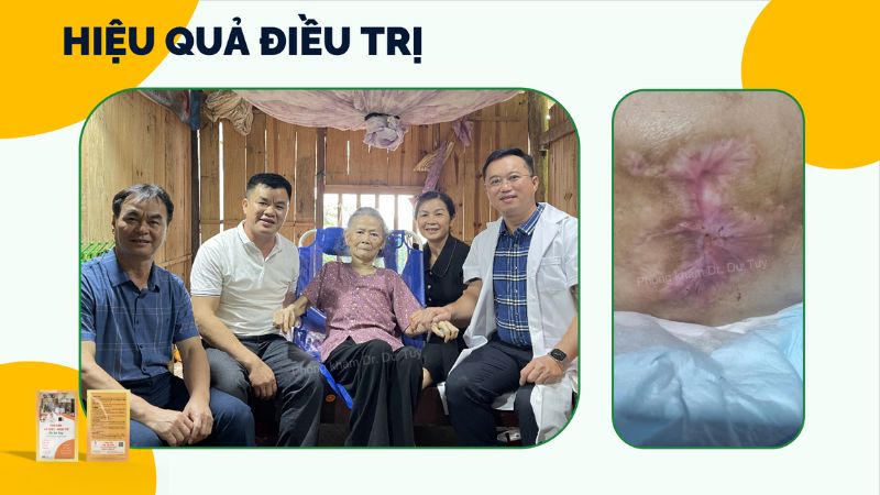 chữa loét da lâu ngày