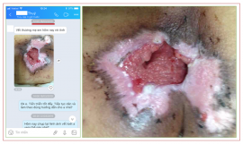 Chuyên điều trị các vết lở loét mất da tại Bắc Giang