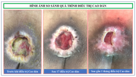 Chuyên điều trị các vết lở loét mất da tại Hà Nội