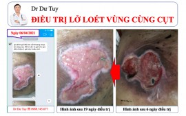 Chuyên điều trị các vết lở loét mất da tại Lai Châu