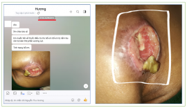 Chuyên điều trị các vết lở loét mất da tại Nam Định