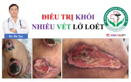 Chuyên điều trị các vết lở loét mất da tại Ninh Bình