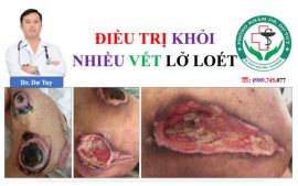Chuyên điều trị các vết lở loét mất da tại Thái Nguyên