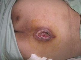 Chuyên điều trị các vết lở loét mất da tại Tuyên Quang