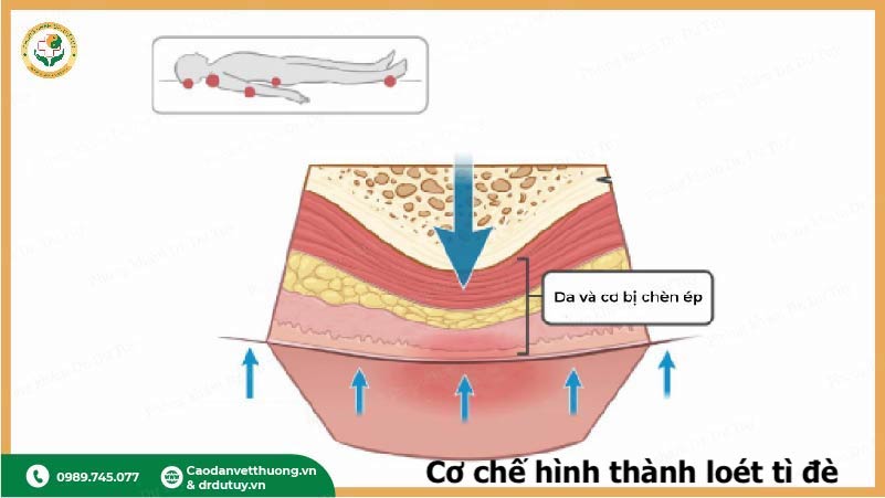 co-che-hinh-thanh-loet-ti-de