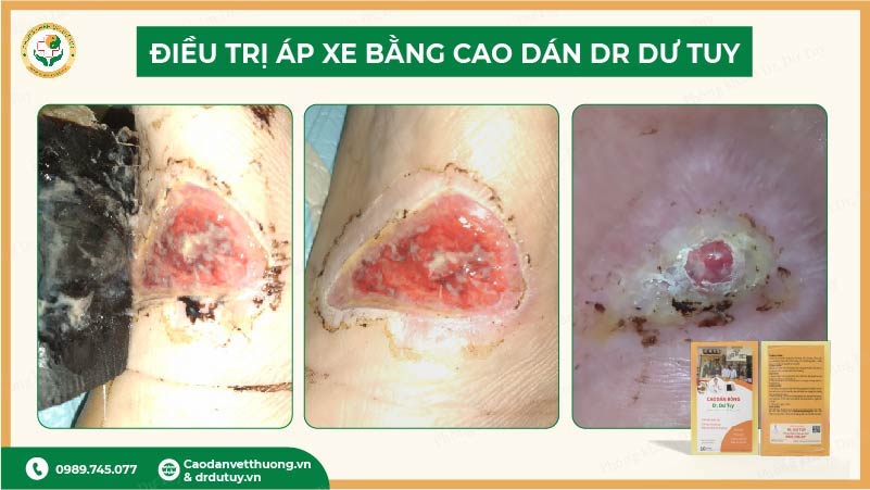 cơ chế hỗ trợ hồi phục của cao dán bỏng bô