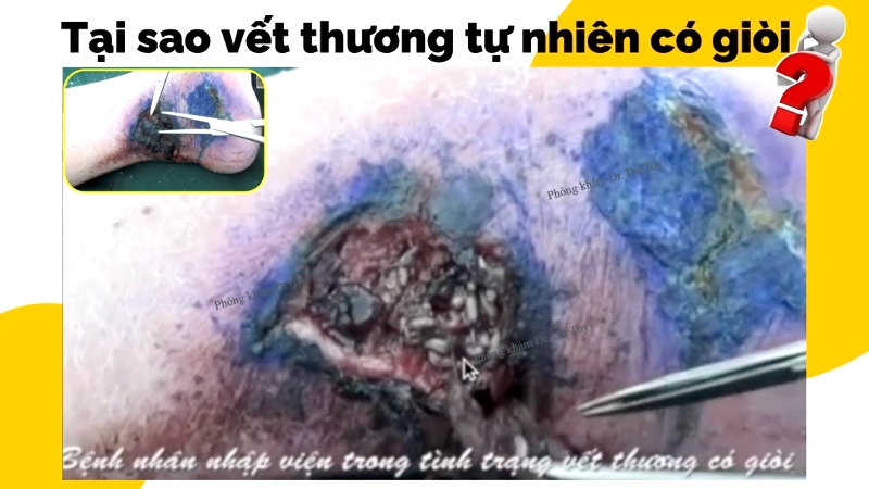 co-che-sinh-gioi-myiasis-theo-y-hoc