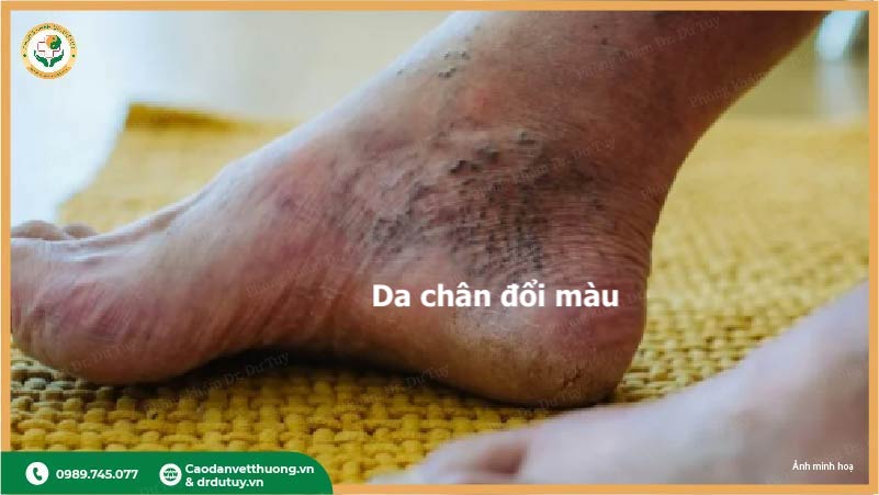 da-chan-doi-mau-do-bien-chung-tieu-duong