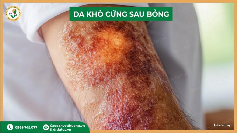 da-kho-cung-sau-bong