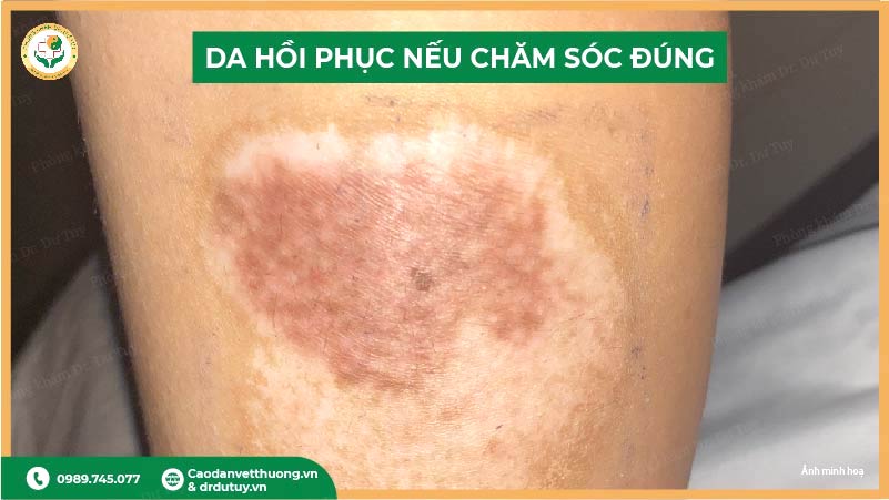 da phục hồi sau bỏng