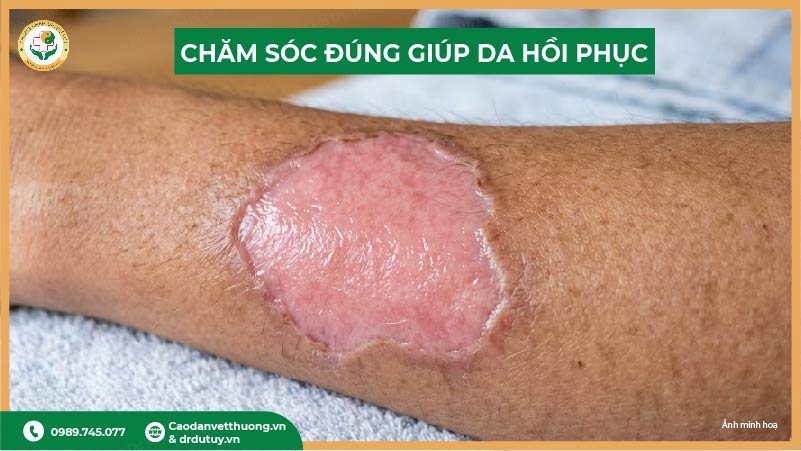 da phục hồi sau vết bỏng