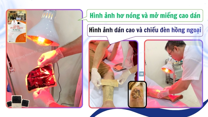 dán cao và chiếu đèn hồng ngoại vết thương