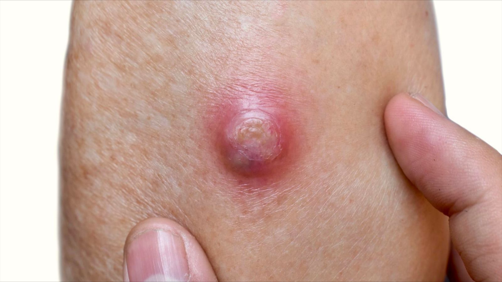 dau-hieu-ap-xe-sau-tiem