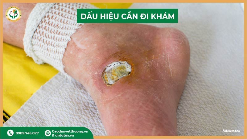 dấu hiệu cần đi khám khi bỏng phồng nước