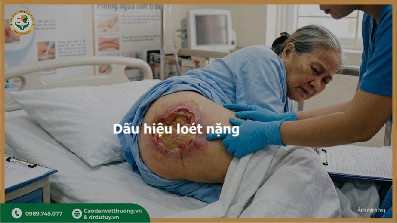 dau-hieu-loet-ti-de-nang-o-nguoi-nam-lau